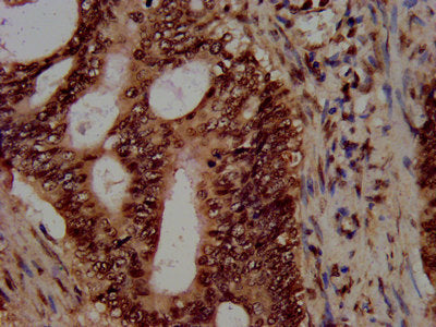 IHC image of HIST1H3A (Ab-4) Antibody diluted at 1:100 and staining in paraffin-embedded human colon cancer performed on a Leica BondTM system. After dewaxing and hydration, antigen retrieval was mediated by high pressure in a citrate buffer (pH 6.0). Section was blocked with 10% normal goat serum 30min at RT. Then primary antibody (1% BSA) was incubated at 4°C overnight. The primary is detected by a biotinylated secondary antibody and visualized using an HRP conjugated SP system.Rabbit anti-Human HIST1H3A Polyclonal Antibody