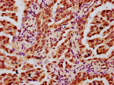 IHC image of HIST1H3A (Ab-4) Antibody diluted at 1:20 and staining in paraffin-embedded human lung cancer performed on a Leica BondTM system. After dewaxing and hydration, antigen retrieval was mediated by high pressure in a citrate buffer (pH 6.0). Section was blocked with 10% normal goat serum 30min at RT. Then primary antibody (1% BSA) was incubated at 4°C overnight. The primary is detected by a biotinylated secondary antibody and visualized using an HRP conjugated SP system.Rabbit anti-Human HIST1H3A Polyclonal Antibody