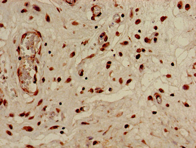 Immunohistochemistry of paraffin-embedded human lung cancer using HIST1H3A (Ab-4) Antibody at dilution of 1:100Rabbit anti-Human HIST1H3A Polyclonal Antibody
