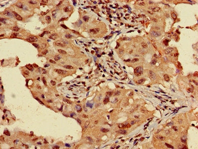 Immunohistochemistry of paraffin-embedded human lung cancer using HIST1H3A (Ab-4) Antibody at dilution of 1:100Rabbit anti-Human HIST1H3A Polyclonal Antibody