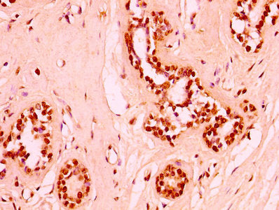 IHC image of HIST1H3A (Ab-6) Antibody diluted at 1:50 and staining in paraffin-embedded human breast cancer performed on a Leica BondTM system. After dewaxing and hydration, antigen retrieval was mediated by high pressure in a citrate buffer (pH 6.0). Section was blocked with 10% normal goat serum 30min at RT. Then primary antibody (1% BSA) was incubated at 4°C overnight. The primary is detected by a biotinylated secondary antibody and visualized using an HRP conjugated SP system.Rabbit anti-Human HIST1H3A Polyclonal Antibody