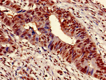 Immunohistochemistry of paraffin-embedded human colon cancer using HIST1H3A (Ab-9) Antibody at dilution of 1:100Rabbit anti-Human HIST1H3A Polyclonal Antibody