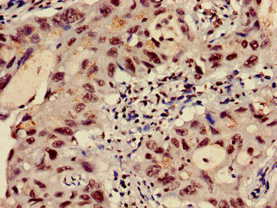 Immunohistochemistry of paraffin-embedded human lung cancer using HIST1H3A (Ab-9) Antibody at dilution of 1:100Rabbit anti-Human HIST1H3A Polyclonal Antibody