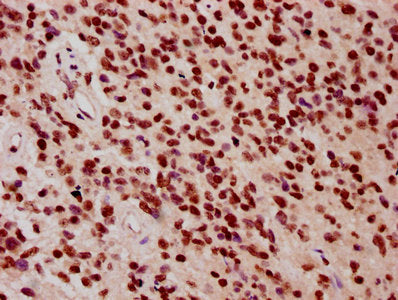 IHC image of HIST1H3A (Ab-9) Antibody diluted at 1:10 and staining in paraffin-embedded human glioma performed on a Leica BondTM system. After dewaxing and hydration, antigen retrieval was mediated by high pressure in a citrate buffer (pH 6.0). Section was blocked with 10% normal goat serum 30min at RT. Then primary antibody (1% BSA) was incubated at 4°C overnight. The primary is detected by a biotinylated secondary antibody and visualized using an HRP conjugated SP system.Rabbit anti-Human HIST1H3A Polyclonal Antibody