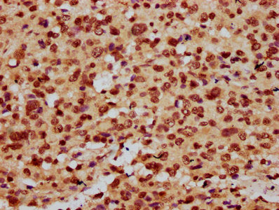 IHC image of HIST1H3A (Ab-9) Antibody diluted at 1:20 and staining in paraffin-embedded human glioma performed on a Leica BondTM system. After dewaxing and hydration, antigen retrieval was mediated by high pressure in a citrate buffer (pH 6.0). Section was blocked with 10% normal goat serum 30min at RT. Then primary antibody (1% BSA) was incubated at 4°C overnight. The primary is detected by a biotinylated secondary antibody and visualized using an HRP conjugated SP system.Rabbit anti-Human HIST1H3A Polyclonal Antibody