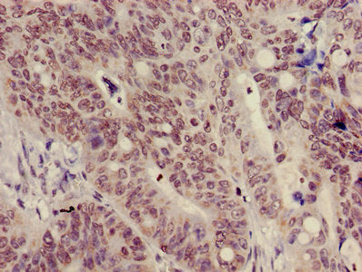 Immunohistochemistry of paraffin-embedded human colon cancer using HIST1H3A (Ab-9) Antibody at dilution of 1:100Rabbit anti-Human HIST1H3A Polyclonal Antibody