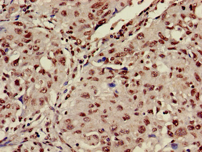 Immunohistochemistry of paraffin-embedded human lung cancer using HIST1H3A (Ab-9) Antibody at dilution of 1:100Rabbit anti-Human HIST1H3A Polyclonal Antibody