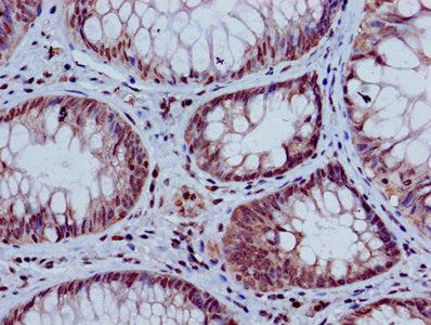 Immunohistochemistry of paraffin-embedded human colon cancer using HIST1H3A (Ab-9) Antibody at dilution of 1:100Rabbit anti-Human HIST1H3A Polyclonal Antibody