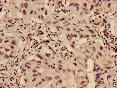 Immunohistochemistry of paraffin-embedded human lung cancer using HIST1H3A (Ab-9) Antibody at dilution of 1:100Rabbit anti-Human HIST1H3A Polyclonal Antibody