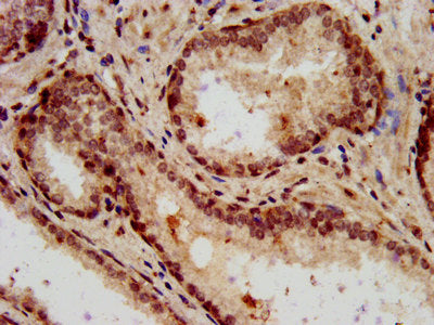 IHC image of HIST1H3A (Ab-10) Antibody diluted at 1:7 and staining in paraffin-embedded human prostate cancer performed on a Leica BondTM system. After dewaxing and hydration, antigen retrieval was mediated by high pressure in a citrate buffer (pH 6.0). Section was blocked with 10% normal goat serum 30min at RT. Then primary antibody (1% BSA) was incubated at 4°C overnight. The primary is detected by a biotinylated secondary antibody and visualized using an HRP conjugated SP system.Rabbit anti-Human HIST1H3A Polyclonal Antibody