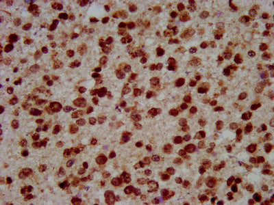 IHC image of HIST1H3A (Ab-10) Antibody diluted at 1:7 and staining in paraffin-embedded human glioma performed on a Leica BondTM system. After dewaxing and hydration, antigen retrieval was mediated by high pressure in a citrate buffer (pH 6.0). Section was blocked with 10% normal goat serum 30min at RT. Then primary antibody (1% BSA) was incubated at 4°C overnight. The primary is detected by a biotinylated secondary antibody and visualized using an HRP conjugated SP system.Rabbit anti-Human HIST1H3A Polyclonal Antibody