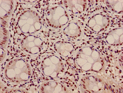 Immunohistochemistry of paraffin-embedded human colon cancer using HIST1H3A (Ab-10) Antibody at dilution of 1:100Rabbit anti-Human HIST1H3A Polyclonal Antibody