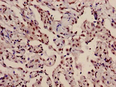 Immunohistochemistry of paraffin-embedded human lung cancer using HIST1H3A (Ab-10) Antibody at dilution of 1:100Rabbit anti-Human HIST1H3A Polyclonal Antibody