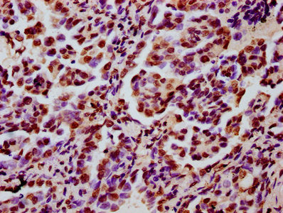 IHC image of HIST1H3A (Ab-122) Antibody diluted at 1:5 and staining in paraffin-embedded human lung cancer performed on a Leica BondTM system. After dewaxing and hydration, antigen retrieval was mediated by high pressure in a citrate buffer (pH 6.0). Section was blocked with 10% normal goat serum 30min at RT. Then primary antibody (1% BSA) was incubated at 4°C overnight. The primary is detected by a biotinylated secondary antibody and visualized using an HRP conjugated SP system.Rabbit anti-Human HIST1H3A Polyclonal Antibody