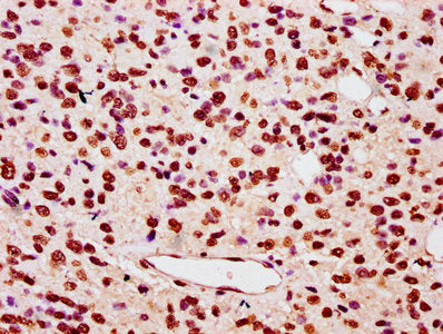 IHC image of HIST1H3A (Ab-122) Antibody diluted at 1:5 and staining in paraffin-embedded human glioma performed on a Leica BondTM system. After dewaxing and hydration, antigen retrieval was mediated by high pressure in a citrate buffer (pH 6.0). Section was blocked with 10% normal goat serum 30min at RT. Then primary antibody (1% BSA) was incubated at 4°C overnight. The primary is detected by a biotinylated secondary antibody and visualized using an HRP conjugated SP system.Rabbit anti-Human HIST1H3A Polyclonal Antibody