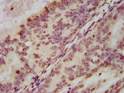 IHC image of HIST1H3A (Ab-122) Antibody diluted at 1:100 and staining in paraffin-embedded human endometrial cancer performed on a Leica BondTM system. After dewaxing and hydration, antigen retrieval was mediated by high pressure in a citrate buffer (pH 6.0). Section was blocked with 10% normal goat serum 30min at RT. Then primary antibody (1% BSA) was incubated at 4°C overnight. The primary is detected by a biotinylated secondary antibody and visualized using an HRP conjugated SP system.Rabbit anti-Human HIST1H3A Polyclonal Antibody