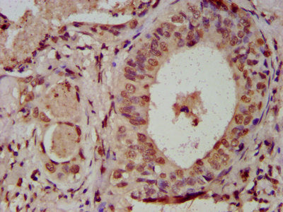 IHC image of HIST1H3A (Ab-122) Antibody diluted at 1:100 and staining in paraffin-embedded human cervical cancer performed on a Leica BondTM system. After dewaxing and hydration, antigen retrieval was mediated by high pressure in a citrate buffer (pH 6.0). Section was blocked with 10% normal goat serum 30min at RT. Then primary antibody (1% BSA) was incubated at 4°C overnight. The primary is detected by a biotinylated secondary antibody and visualized using an HRP conjugated SP system.Rabbit anti-Human HIST1H3A Polyclonal Antibody