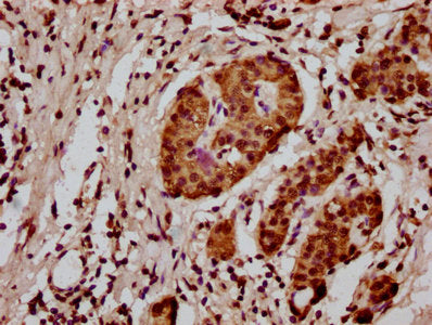IHC image of the antibody diluted at 1:20 and staining in paraffin-embedded human pancreatic cancer performed on a Leica BondTM system. After dewaxing and hydration, antigen retrieval was mediated by high pressure in a citrate buffer (pH 6.0). Section was blocked with 10% normal goat serum 30min at RT. Then primary antibody (1% BSA) was incubated at 4°C overnight. The primary is detected by a biotinylated secondary antibody and visualized using an HRP conjugated SP system.Rabbit anti-Human HIST1H3A Polyclonal Antibody