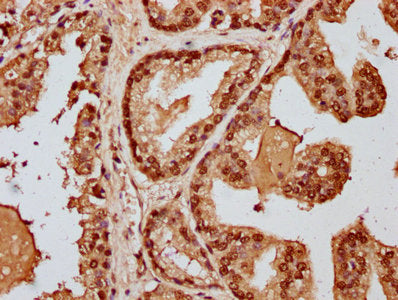 IHC image of HIST1H3A (Ab-128) Antibody diluted at 1:20 and staining in paraffin-embedded human prostate cancer performed on a Leica BondTM system. After dewaxing and hydration, antigen retrieval was mediated by high pressure in a citrate buffer (pH 6.0). Section was blocked with 10% normal goat serum 30min at RT. Then primary antibody (1% BSA) was incubated at 4°C overnight. The primary is detected by a biotinylated secondary antibody and visualized using an HRP conjugated SP system.Rabbit anti-Human HIST1H3A Polyclonal Antibody