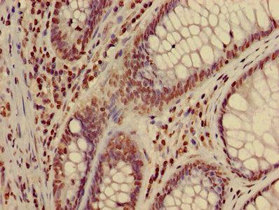 Immunohistochemistry of paraffin-embedded human colon cancer using HIST1H3A (Ab-17) Antibody at dilution of 1:100Rabbit anti-Human HIST1H3A Polyclonal Antibody