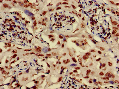 Immunohistochemistry of paraffin-embedded human lung cancer using HIST1H3A (Ab-17) Antibody at dilution of 1:100Rabbit anti-Human HIST1H3A Polyclonal Antibody