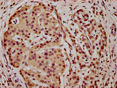 IHC image of HIST1H3A (Ab-18) Antibody diluted at 1:5 and staining in paraffin-embedded human pancreatic cancer performed on a Leica BondTM system. After dewaxing and hydration, antigen retrieval was mediated by high pressure in a citrate buffer (pH 6.0). Section was blocked with 10% normal goat serum 30min at RT. Then primary antibody (1% BSA) was incubated at 4°C overnight. The primary is detected by a biotinylated secondary antibody and visualized using an HRP conjugated SP system.Rabbit anti-Human HIST1H3A Polyclonal Antibody