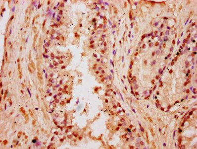 IHC image of HIST1H3A (Ab-18) Antibody diluted at 1:5 and staining in paraffin-embedded human prostate cancer performed on a Leica BondTM system. After dewaxing and hydration, antigen retrieval was mediated by high pressure in a citrate buffer (pH 6.0). Section was blocked with 10% normal goat serum 30min at RT. Then primary antibody (1% BSA) was incubated at 4°C overnight. The primary is detected by a biotinylated secondary antibody and visualized using an HRP conjugated SP system.Rabbit anti-Human HIST1H3A Polyclonal Antibody