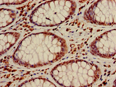 Immunohistochemistry of paraffin-embedded human colon cancer using HIST1H3A (Ab-23) Antibody at dilution of 1:100Rabbit anti-Human HIST1H3A Polyclonal Antibody