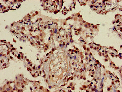 Immunohistochemistry of paraffin-embedded human lung cancer using HIST1H3A (Ab-23) Antibody at dilution of 1:100Rabbit anti-Human HIST1H3A Polyclonal Antibody