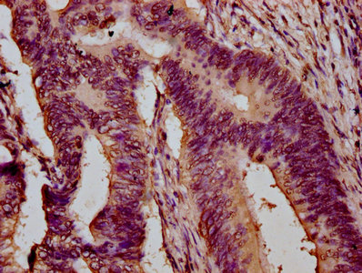 IHC image of HIST1H3A (Ab-23) Antibody diluted at 1:20 and staining in paraffin-embedded human colon cancer performed on a Leica BondTM system. After dewaxing and hydration, antigen retrieval was mediated by high pressure in a citrate buffer (pH 6.0). Section was blocked with 10% normal goat serum 30min at RT. Then primary antibody (1% BSA) was incubated at 4°C overnight. The primary is detected by a biotinylated secondary antibody and visualized using an HRP conjugated SP system.Rabbit anti-Human HIST1H3A Polyclonal Antibody