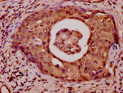 IHC image of HIST1H3A (Ab-23) Antibody diluted at 1:50 and staining in paraffin-embedded human cervical cancer performed on a Leica BondTM system. After dewaxing and hydration, antigen retrieval was mediated by high pressure in a citrate buffer (pH 6.0). Section was blocked with 10% normal goat serum 30min at RT. Then primary antibody (1% BSA) was incubated at 4°C overnight. The primary is detected by a biotinylated secondary antibody and visualized using an HRP conjugated SP system.Rabbit anti-Human HIST1H3A Polyclonal Antibody