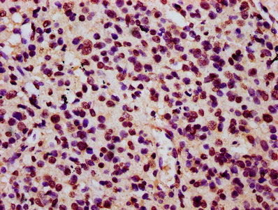 IHC image of HIST1H3A (Ab-27) Antibody diluted at 1:15 and staining in paraffin-embedded human glioma performed on a Leica BondTM system. After dewaxing and hydration, antigen retrieval was mediated by high pressure in a citrate buffer (pH 6.0). Section was blocked with 10% normal goat serum 30min at RT. Then primary antibody (1% BSA) was incubated at 4°C overnight. The primary is detected by a biotinylated secondary antibody and visualized using an HRP conjugated SP system.Rabbit anti-Human HIST1H3A Polyclonal Antibody