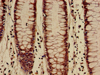 Immunohistochemistry of paraffin-embedded human colon cancer using the antibody at dilution of 1:100Rabbit anti-Human HIST1H3A Polyclonal Antibody