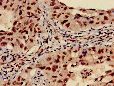 Immunohistochemistry of paraffin-embedded human lung cancer using HIST1H3A (Ab-27) Antibody at dilution of 1:100Rabbit anti-Human HIST1H3A Polyclonal Antibody