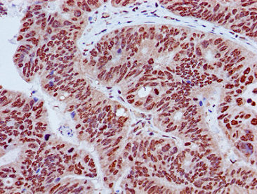 Immunohistochemistry of paraffin-embedded human colon cancer using HIST1H3A (Ab-27) Antibody at dilution of 1:100Rabbit anti-Human HIST1H3A Polyclonal Antibody