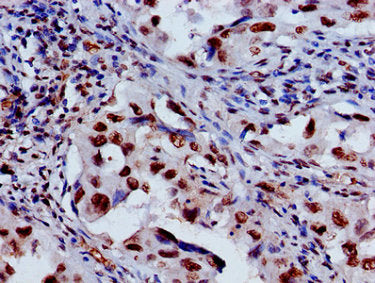 Immunohistochemistry of paraffin-embedded human lung cancer using HIST1H3A (Ab-27) Antibody at dilution of 1:100Rabbit anti-Human HIST1H3A Polyclonal Antibody