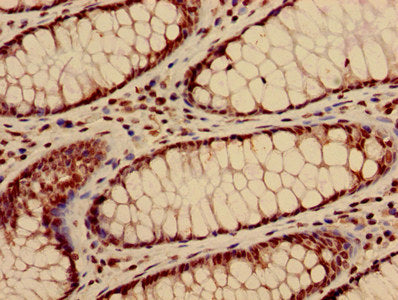 Immunohistochemistry of paraffin-embedded human colon cancer using HIST1H3A (Ab-28) Antibody at dilution of 1:100Rabbit anti-Human HIST1H3A Polyclonal Antibody