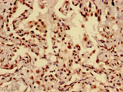Immunohistochemistry of paraffin-embedded human lung cancer using HIST1H3A (Ab-28) Antibody at dilution of 1:100Rabbit anti-Human HIST1H3A Polyclonal Antibody