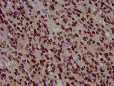 IHC image of HIST1H3A (Ab-36) Antibody diluted at 1:100 and staining in paraffin-embedded human glioma performed on a Leica BondTM system. After dewaxing and hydration, antigen retrieval was mediated by high pressure in a citrate buffer (pH 6.0). Section was blocked with 10% normal goat serum 30min at RT. Then primary antibody (1% BSA) was incubated at 4°C overnight. The primary is detected by a biotinylated secondary antibody and visualized using an HRP conjugated SP system.Rabbit anti-Human HIST1H3A Polyclonal Antibody