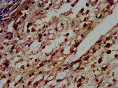 IHC image of HIST1H3A (Ab-36) Antibody diluted at 1:100 and staining in paraffin-embedded human melanoma performed on a Leica BondTM system. After dewaxing and hydration, antigen retrieval was mediated by high pressure in a citrate buffer (pH 6.0). Section was blocked with 10% normal goat serum 30min at RT. Then primary antibody (1% BSA) was incubated at 4°C overnight. The primary is detected by a biotinylated secondary antibody and visualized using an HRP conjugated SP system.Rabbit anti-Human HIST1H3A Polyclonal Antibody