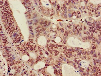 Immunohistochemistry of paraffin-embedded human colon cancer using HIST1H3A (Ab-36) Antibody at dilution of 1:100Rabbit anti-Human HIST1H3A Polyclonal Antibody