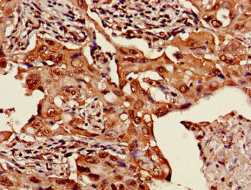 Immunohistochemistry of paraffin-embedded human lung cancer using HIST1H3A (Ab-36) Antibody at dilution of 1:100Rabbit anti-Human HIST1H3A Polyclonal Antibody