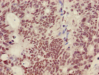 Immunohistochemistry of paraffin-embedded human colon cancer using the antibody at dilution of 1:100Rabbit anti-Human HIST1H3A Polyclonal Antibody