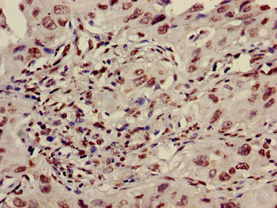 Immunohistochemistry of paraffin-embedded human lung cancer using HIST1H3A (Ab-36) Antibody at dilution of 1:100Rabbit anti-Human HIST1H3A Polyclonal Antibody