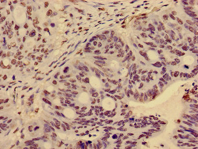 Immunohistochemistry of paraffin-embedded human colon cancer using HIST1H3A (Ab-36) Antibody at dilution of 1:100Rabbit anti-Human HIST1H3A Polyclonal Antibody