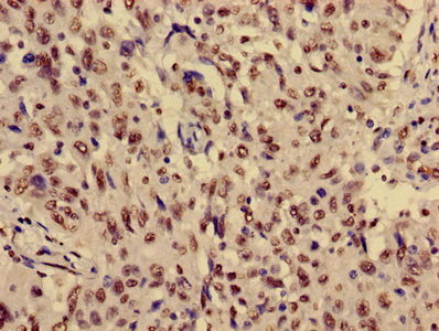 Immunohistochemistry of paraffin-embedded human lung cancer using HIST1H3A (Ab-36) Antibody at dilution of 1:100Rabbit anti-Human HIST1H3A Polyclonal Antibody