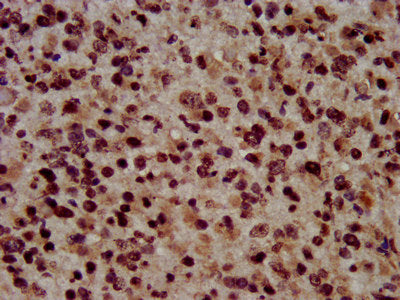 IHC image of HIST1H3A (Ab-45) Antibody diluted at 1:100 and staining in paraffin-embedded human glioma performed on a Leica BondTM system. After dewaxing and hydration, antigen retrieval was mediated by high pressure in a citrate buffer (pH 6.0). Section was blocked with 10% normal goat serum 30min at RT. Then primary antibody (1% BSA) was incubated at 4°C overnight. The primary is detected by a biotinylated secondary antibody and visualized using an HRP conjugated SP system.Rabbit anti-Human HIST1H3A Polyclonal Antibody