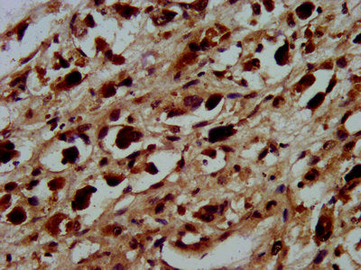 IHC image of HIST1H3A (Ab-45) Antibody diluted at 1:100 and staining in paraffin-embedded human melanoma performed on a Leica BondTM system. After dewaxing and hydration, antigen retrieval was mediated by high pressure in a citrate buffer (pH 6.0). Section was blocked with 10% normal goat serum 30min at RT. Then primary antibody (1% BSA) was incubated at 4°C overnight. The primary is detected by a biotinylated secondary antibody and visualized using an HRP conjugated SP system.Rabbit anti-Human HIST1H3A Polyclonal Antibody