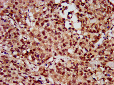IHC image of the antibody diluted at 1: 10 and staining in paraffin-embedded human ovarian cancer performed on a Leica BondTM system. After dewaxing and hydration, antigen retrieval was mediated by high pressure in a citrate buffer (pH 6.0). Section was blocked with 10% normal goat serum 30min at RT. Then primary antibody (1% BSA) was incubated at 4°C overnight. The primary is detected by a biotinylated secondary antibody and visualized using an HRP conjugated SP system.Rabbit anti-Human HIST1H3A Polyclonal Antibody