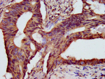 IHC image of HIST1H3A (Ab-56) Antibody diluted at 1: 10 and staining in paraffin-embedded human colon cancer performed on a Leica BondTM system. After dewaxing and hydration, antigen retrieval was mediated by high pressure in a citrate buffer (pH 6.0). Section was blocked with 10% normal goat serum 30min at RT. Then primary antibody (1% BSA) was incubated at 4°C overnight. The primary is detected by a biotinylated secondary antibody and visualized using an HRP conjugated SP system.Rabbit anti-Human HIST1H3A Polyclonal Antibody